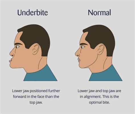 How to fix Underbite? Can invisalign fix underbite or braces