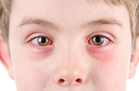 Pink Eye vs Stye: How To Tell The Difference | Dr. Bishop & Associates