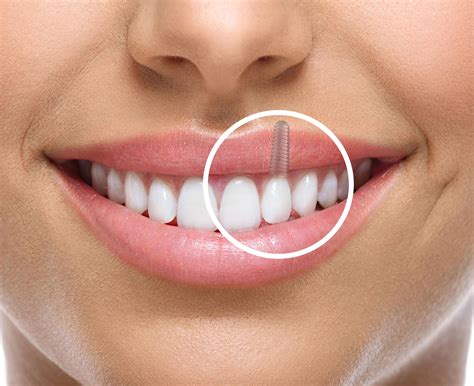 Brighton Oral Surgeon | About Dental Impalnts