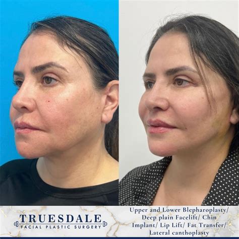 Facial Fat Transfer Beverly Hills | Truesdale Facial Plastic Surgery