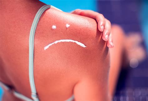 Sun Poisoning Vs. Sunburn | The Well by Northwell