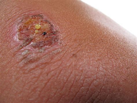 Essential Signs of an Infected Wound - Discovery Health Journal - Health and wellness knowledge