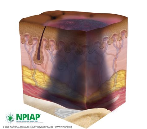 What Is National Pressure Ulcer Advisory Panel at Verda Garcia blog
