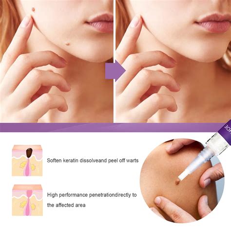 Buy Skin Wart Remover Salicylic Acid 17% Removedor de Verrugas Online at Lowest Price in India ...