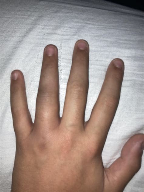Is my finger broken or jammed/sprained? Ring finger specifically. : r ...