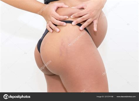 Closeup Pregnant Woman Stretch Marks Buttocks Isolated White — Stock Photo © moviafilmes #221274196