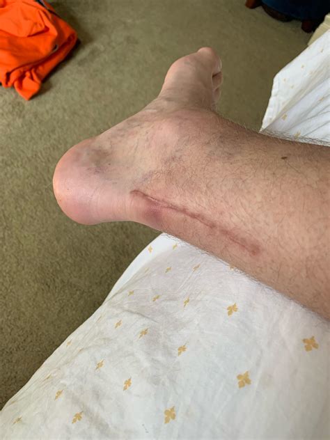 Achilles tendon has a lump new arrivals