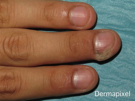 Porque Salen Los Mezquinos En Niños - caliberbaby