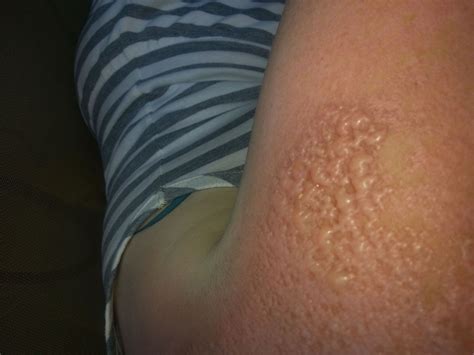 Second Degree Burn Care Plan at Juliane Michaelis blog