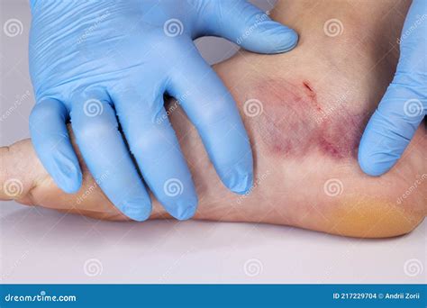 Doctor is Examining an Injured Foot with Bruise and Scratch. Bruise on Womans Leg Skin Stock ...