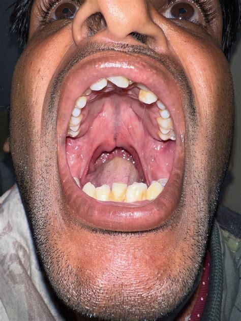 Cleft Palate | Treatment & Management | Point of Care