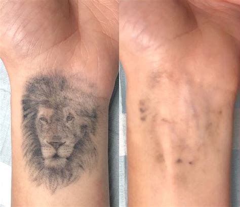 ¿Láser o Cover Up, qué elegir para tu viejo tatuaje?