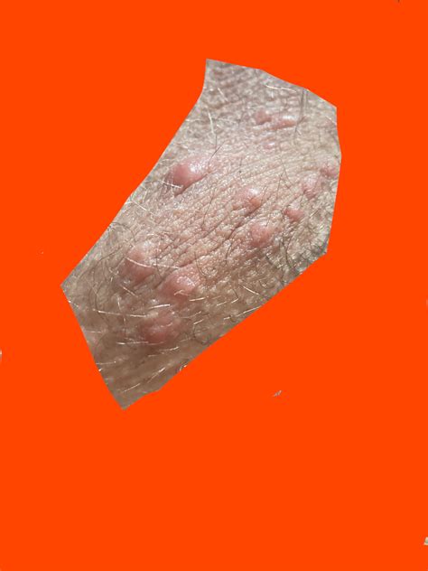 White Spots On My Testicles , Rash on penis: 10 most common causes with pictures – ODZL