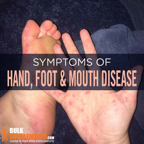 How To Cure Foot And Mouth Disease - Dreamopportunity25