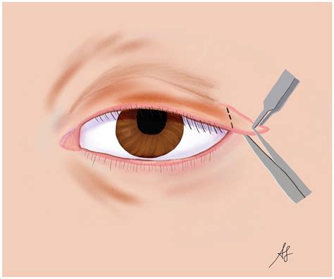 The Overlooked Floppy Eyelid Syndrome: From Diagnosis to Medical and ...