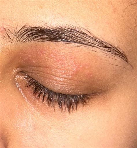 Small rash on eyelid : r/skin