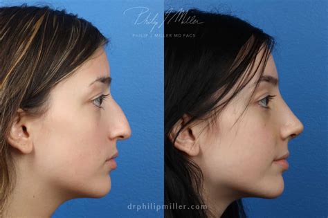 What Rhinoplasty Cost to Expect in New York: A Full Guide