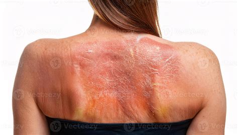 Sunburn And Peeling Skin