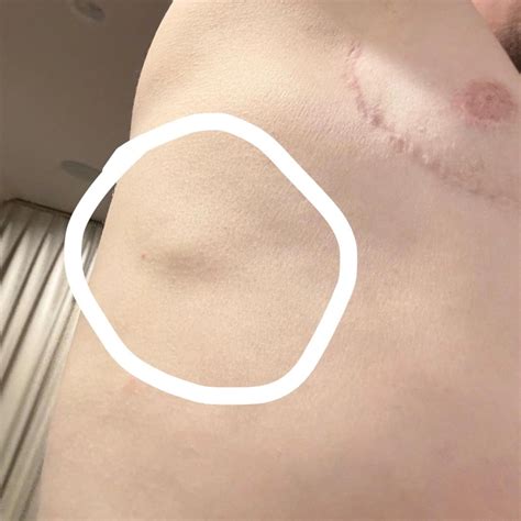 Lump Under Skin on Rib Cage Armpit for 17 Years
