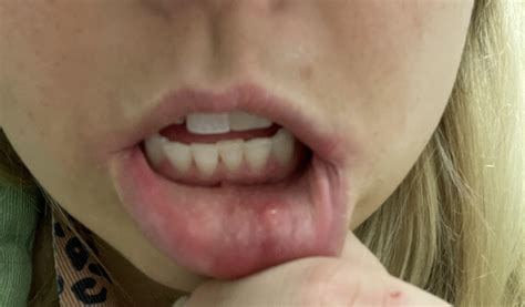 What is this lump under my bottom lip on the inside of my mouth? : r/askdentists