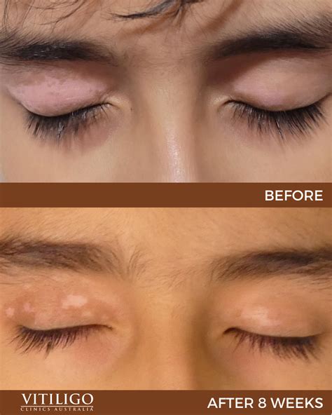 Iris Vitiligo Eyes at Alyssa Wekey blog