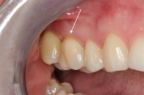 Understanding Gum Recession: Causes, Symptoms, Prevention, and Treatment — Nova Smiles
