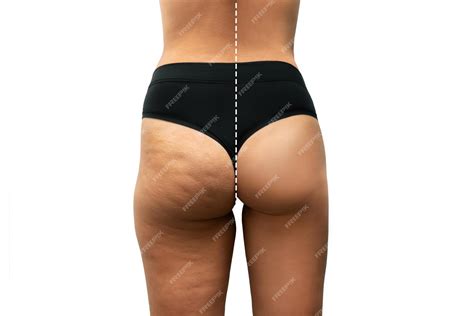 Premium Photo | Young woman's thighs and buttocks with cellulite before after treatment and ...