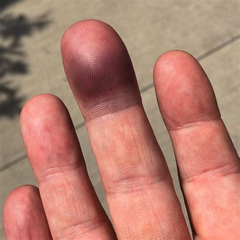 Bruised Middle Finger