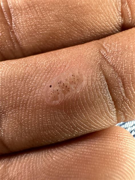 Syphilis chancre with hair? : r/DermatologyQuestions