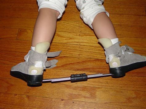 About NoSurgery4 Clubfoot? | Non-Surgical Clubfoot Treatment - The ...