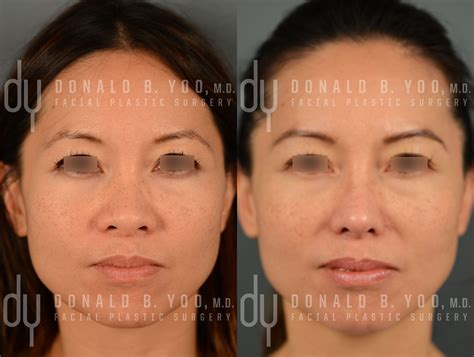 Before and After primary Asian rhinoplasty. The patient underwent rib cartilage harvest, diced ...