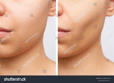 Facial Fat Removal Photos, Images & Pictures | Shutterstock