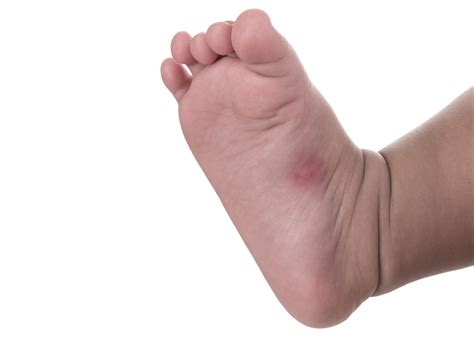 Babies And Bug Bites- How To Treat And Prevent - My Pure Delivery