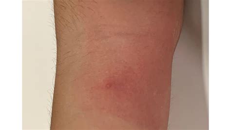 Picaduras De Chinches Y Pulgas: Análisis Del Dermatólogo