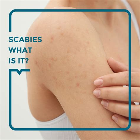 Scabies: symptoms, treatments, and prevention - Alegria Medical Centre