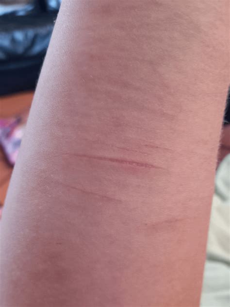 One month old liver transplant scar : r/scars