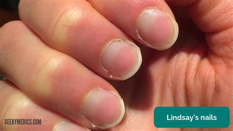 Kidney Disease Symptoms On Nails at Steven Martines blog