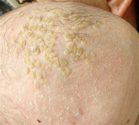 Seborrheic Dermatitis - Pediatric Dermatology