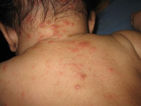Common Baby Rashes On Belly at Sherlyn Weyer blog