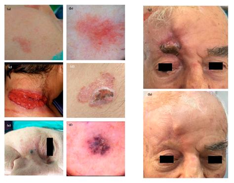 Non-Melanoma Skin Cancers: Biological and Clinical Features