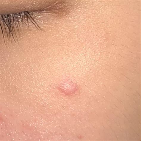 What Is Bumps On Face at Wilma Arrington blog