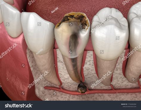 Periostitis Tooth Lump On Gum Above Stock Illustration 1710200284 ...