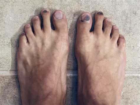 Runners Toenail Problems
