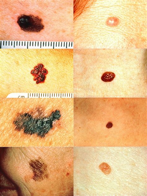 Does This Look Like Melanoma - Infoupdate.org