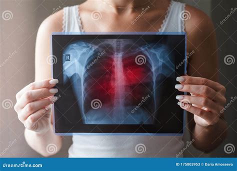 Lung Radiography Concept. Virus and Bacteria Infected the Human Lungs. Patient with Lung Cancer ...