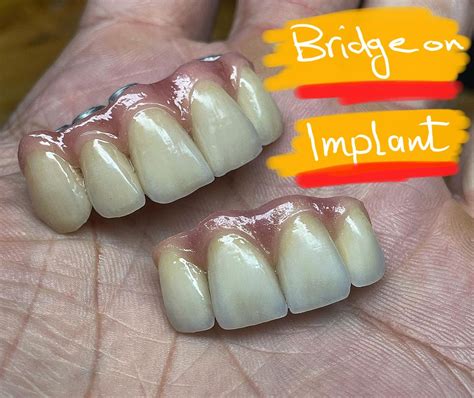 Anterior teeth implants and bridges Teeth Implants, Dental Implants, Tooth Bridge, Dental ...