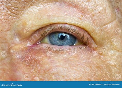 Jaundice Eyes Swollen at Rudolph Miller blog