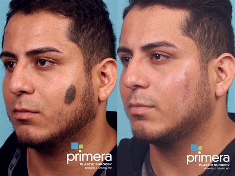 Plastic Surgery For Scars On Face Cost