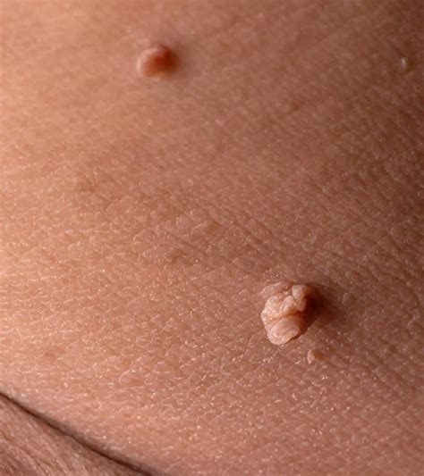 Genital Skin Tag Removal At Home