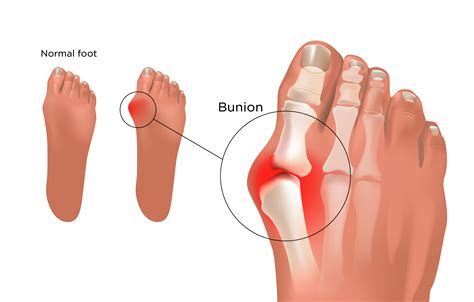 What is Bunion? How it can be treated in Ayurveda?